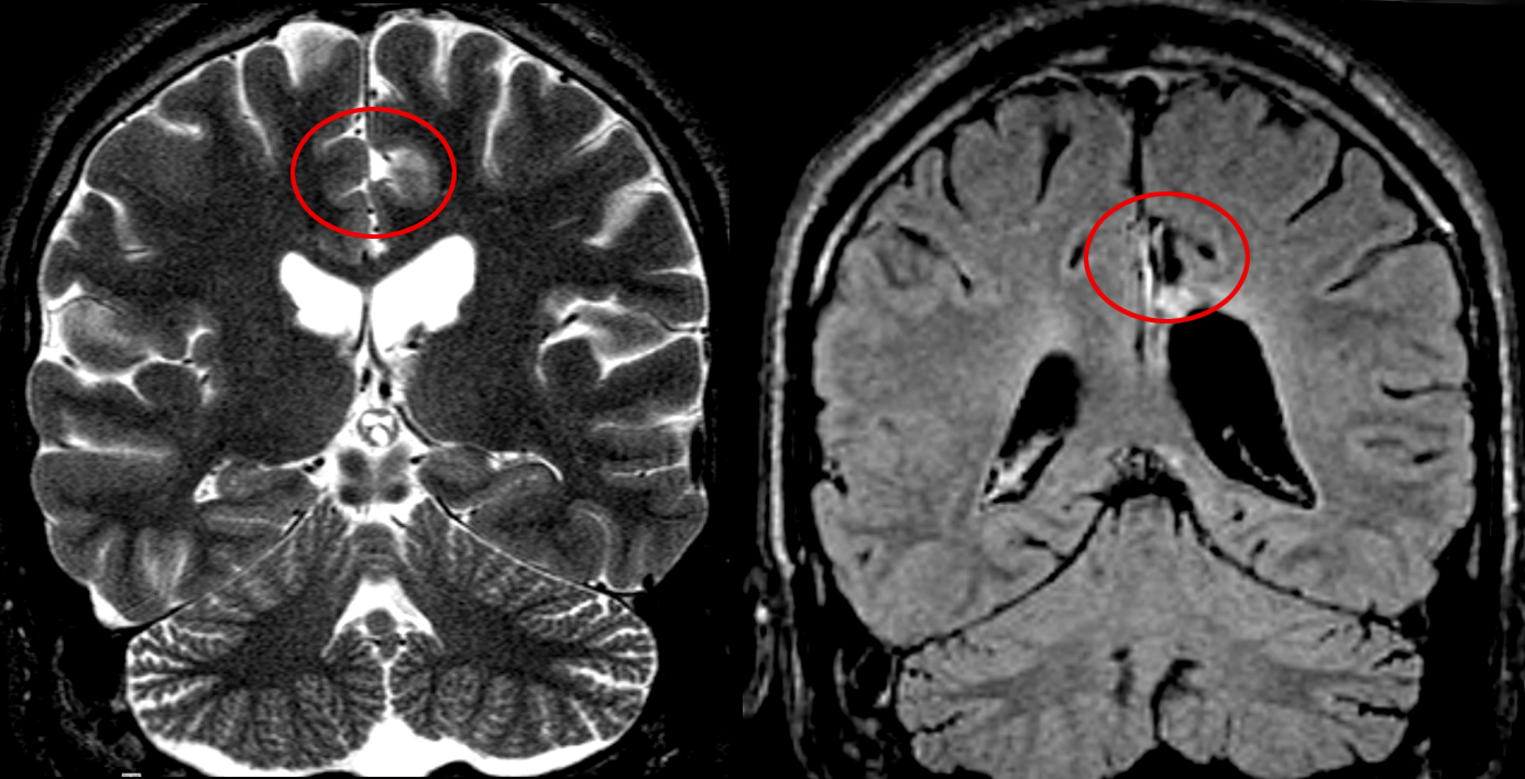 Epilepsie-Chirurgie.jpg