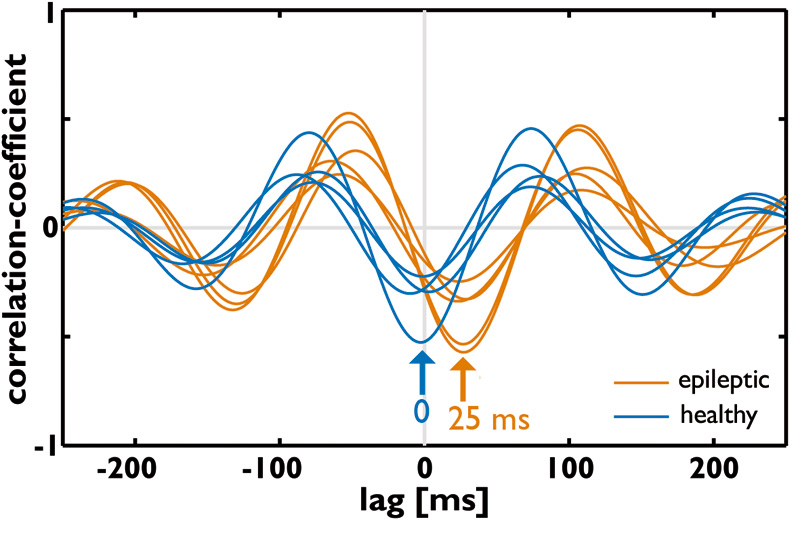 Epileptic signatures - outside of epileptic seizures: Scientists find changes in brain networks during ‘normal’ activity between epileptic episodes