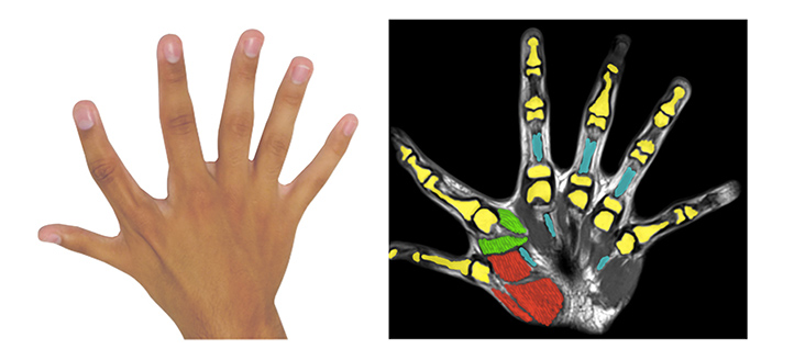 Six fingers per hand: A congenital additional finger brings motor advantages 