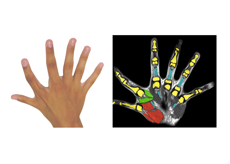 Six fingers per hand: A congenital additional finger brings motor advantages