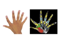 Six fingers per hand: A congenital additional finger brings motor advantages