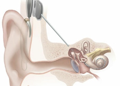 Cochlear implant as a sensor - Freiburg researchers develop more intelligent intracochlear implants